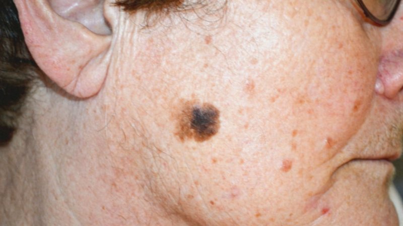 Hautkrebs droht, wenn die UV-Strahlung der Sonne nicht von der Ozonschicht gefiltert wird. – Bild: BR/SWR Hautkrebs droht, wenn die UV-Strahlung der Sonne nicht von der Ozonschicht gefiltert wird. – Bild: BR/SWR