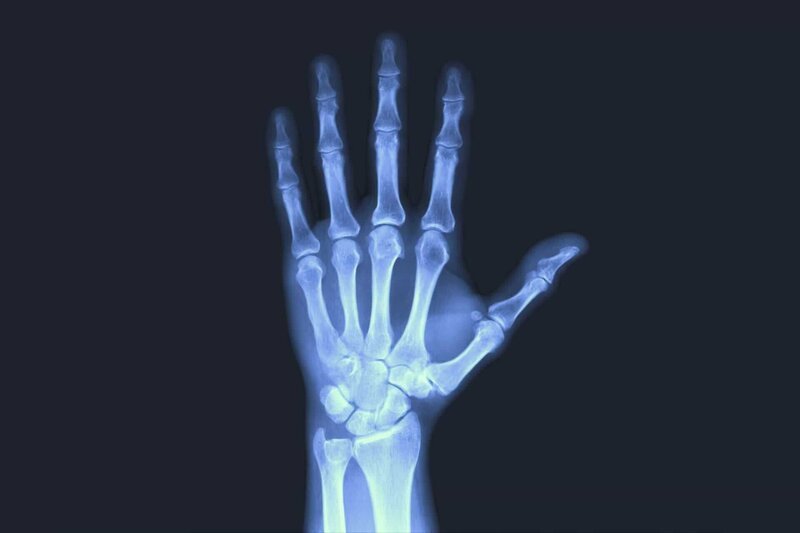 X-rayed human hand. X-ray of hand bones – Bild: shutterstock