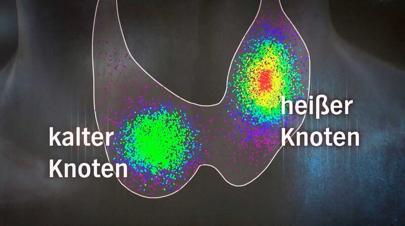 Schilddrüse Grafik: Kalter Knoten /​ heißer Knoten. – Bild: HR