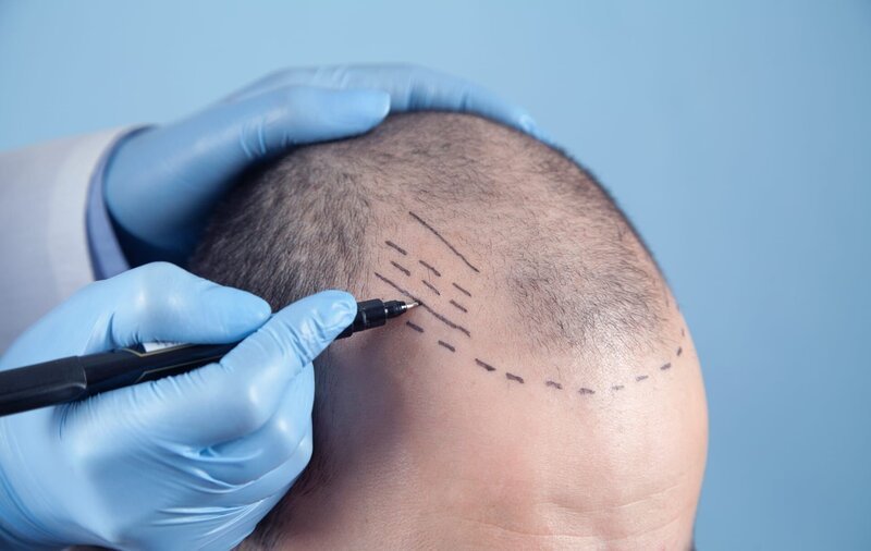Patient mit Haarausfall in Absprache mit einem Arzt. Arzt verwendet Hautmarker. – Bild: Shutterstock /​ ANDRANIK HAKOBYAN