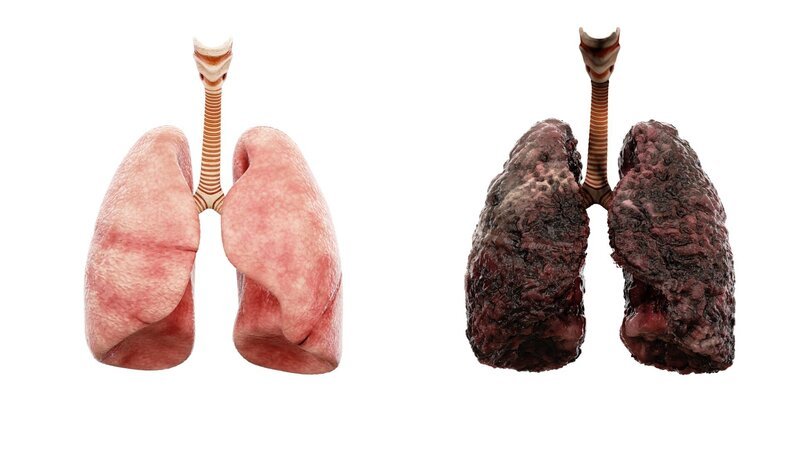 healthy lungs and disease lungs on white isolate. Autopsy medical concept. Cancer and smoking problem – Bild: photographee.eu
