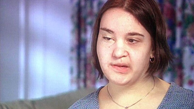 Vickis Gesicht ist für den Rest ihres Lebens entstellt. Als Kind wurde sie von einem Auto überfahren. – Bild: RTL