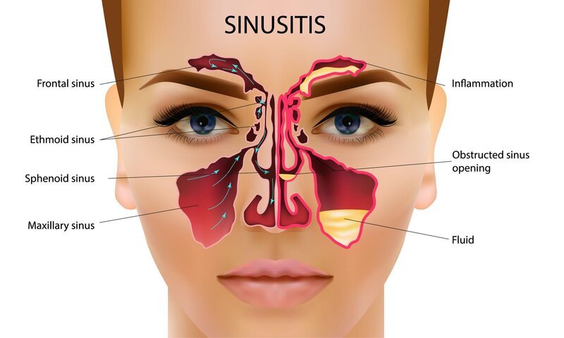 Sinusitis. Healthy and inflammatory sinus. breath sounds. Arrow the ducts of the nose to drain the pus Spitz – Bild: depositphotos