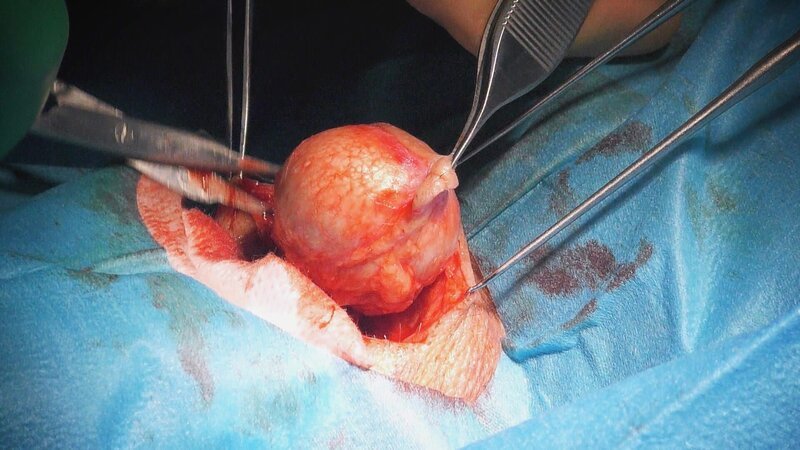 Doctors in the dermatology clinic are operating on the largest and most curious tumor. – Bild: TLC