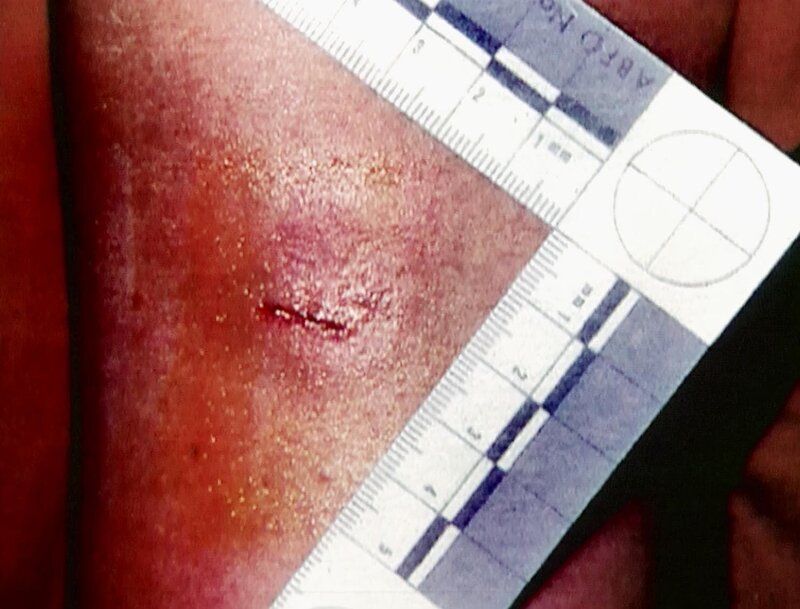 Florida 1993: Zum Glück hat sich ein Opfer gegen den Touristen-Mörder zur Wehr gesetzt und überlebt. Eine Bisswunde erweist sich als heiße Spur. – Bild: RTL