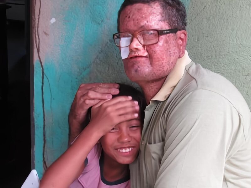 Sun intolerant villager with skin graft face with daughter. – Bild: CH Media /​ Roger Chapman /​ Discovery Communications