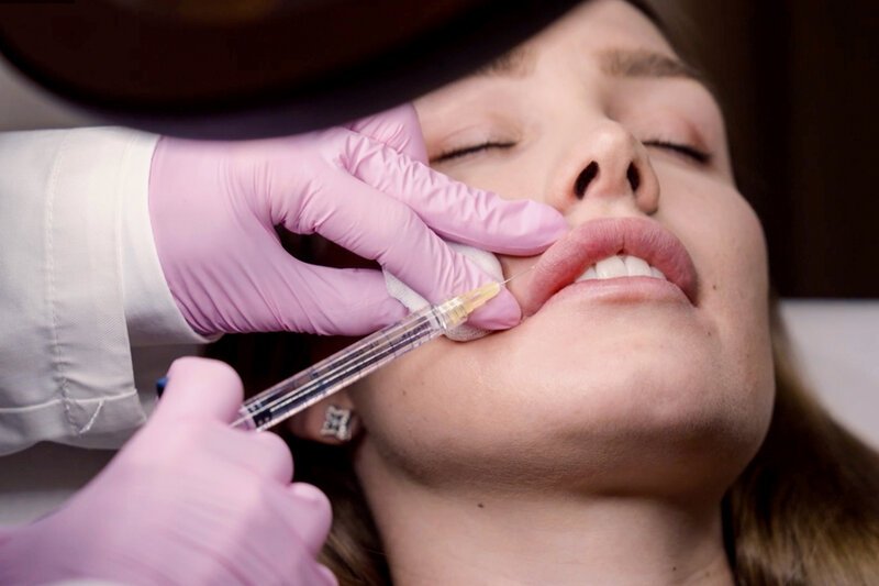 Alles für die Schönheit – Perfektion dank Spritze und Skalpell Folge 1 Aufgrund eines Unfalls muss sich Estelle regelmässig die Lippen aufspritzen lassen. – Bild: SRF/​Phiadelphia Medien GmbH