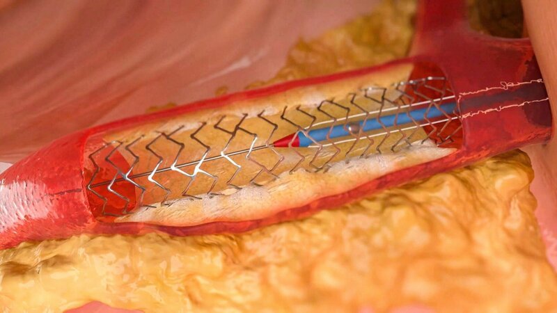 Die Überlebenschance bei einem Herzinfarkt ist durch den sogenannten „Stent“ – ein Implantat aus Metall – deutlich gestiegen. – Bild: ORF/ORF Vorarlberg Die Überlebenschance bei einem Herzinfarkt ist durch den sogenannten „Stent“ – ein Implantat aus Metall – deutlich gestiegen. – Bild: ORF/ORF Vorarlberg