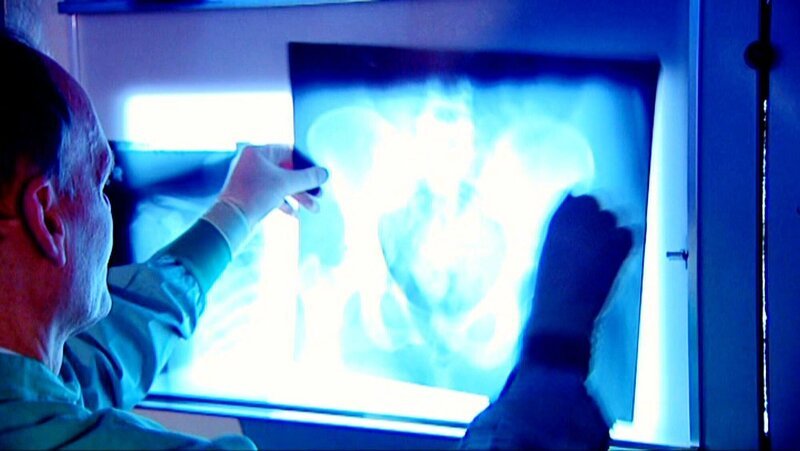 Fall „Vom Metzger zerteilt“: Der Mörder wollte offenbar auf Nummer sicher gehen. Bei der Obduktion des Torsos durch Rechtmediziner Dr. Detlef Günther stellt sich heraus: Zuerst erschießt der Täter sein Opfer, dann sticht er ihm gezielt ins Herz und danach wird die Leiche fachmännisch zerlegt. – Bild: RTL