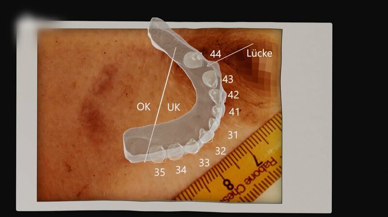 Mit moderner Technik kann der Gebissabdruck simuliert werden. – Bild: ZDF und Polizei Aschaffenburg