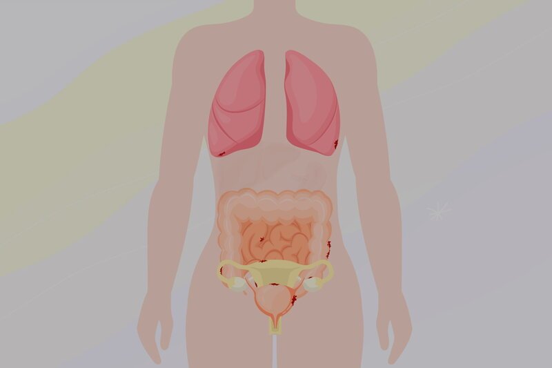 SRF DOK Endometriose Bei der Krankheit „Endometriose“ wächst Gewebe, das der Gebärmutterschleimhaut ähnelt, dort, wo es nicht hingehört, zum Beispiel außerhalb der Gebärmutter, an den Eierstöcken, im Bauch- und Beckenraum, an der Blase oder im Darm. Es kann sich aber auch an anderen Stellen des Körpers, wie der Lunge, ansiedeln. – Bild: SRF1