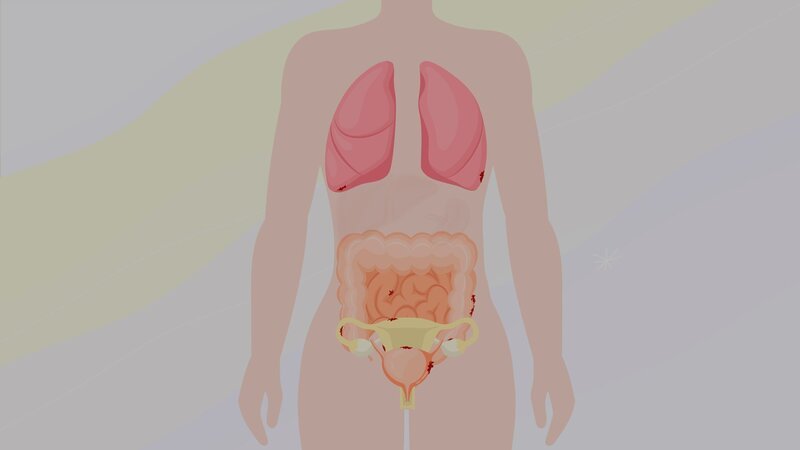 Illustration: Bei der Krankheit „Endometriose“ wächst Gewebe, das der Gebärmutterschleimhaut ähnelt, dort, wo es nicht hingehört, zum Beispiel außerhalb der Gebärmutter, an den Eierstöcken, im Bauch- und Beckenraum, an der Blase oder im Darm. Es kann sich aber auch an anderen Stellen des Körpers, wie der Lunge, ansiedeln. – Bild: SRF/​Alessandra Leone