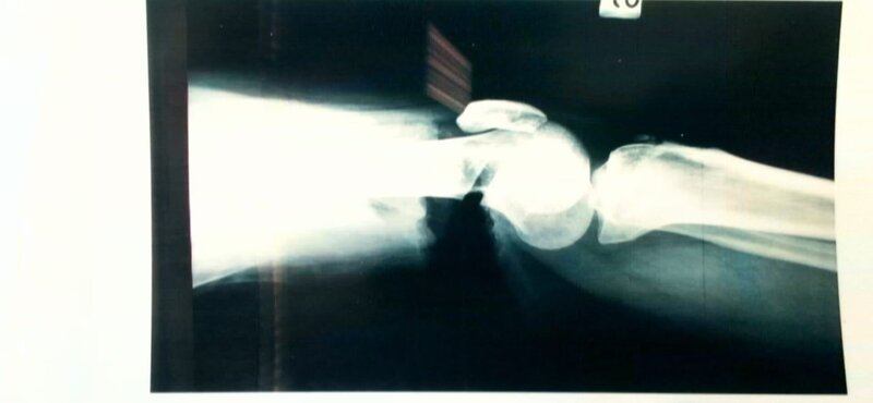 Das Röntgenbild des Oberschenkelknochens des Opfers: Es zeigt einen starken Einschnitt im Knochen. – Bild: ZDF und Polizei Bozen