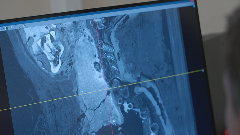 Selbst nach Jahrtausenden sind medizinische Diagnosen möglich: Dieser Verstorbene hatte zu Lebzeiten Arthrose und Karies. – Bild: ZED_MOMIES /​ ZDF
