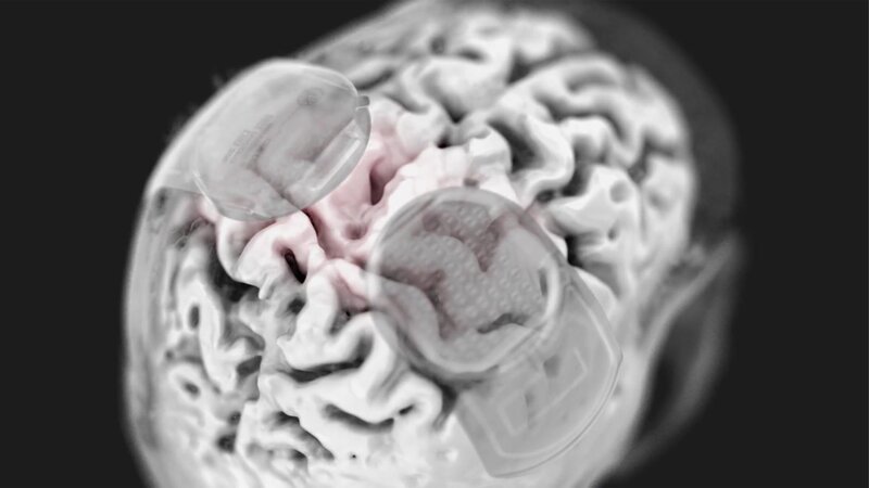 Dieses Bild zeigt eine Gehirn-Computer-Schnittstelle (BCI), eine medizinische Technologie, die eine direkte Kommunikation zwischen dem Gehirn und einem externen Gerät ermöglicht. – Bild: CuriosityStream-Inc