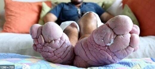 Infected feet – Bild: PLURIMEDIA (Discovery Science)