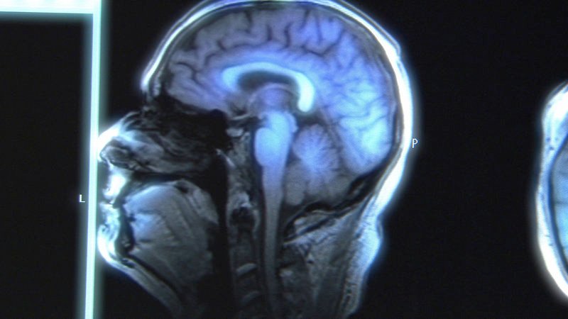 Bei Schizophrenie erleben wir zahlreiche kognitive Beeinträchtigungen. Das beginnt mit der Fähigkeit des Gehirns, sich zu konzentrieren und Aufmerksamkeit aufrecht zu erhalten. Das Signal ist nicht so klar, wie man es gerne hätte – Bild: ARTE France Bei Schizophrenie erleben wir zahlreiche kognitive Beeinträchtigungen. Das beginnt mit der Fähigkeit des Gehirns, sich zu konzentrieren und Aufmerksamkeit aufrecht zu erhalten. Das Signal ist nicht so klar, wie man es gerne hätte – Bild: ARTE France